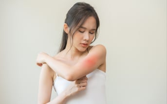 Allergia alle zanzare: cause e sintomi