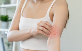Irritazione della pelle: i nostri rimedi e soluzioni naturali